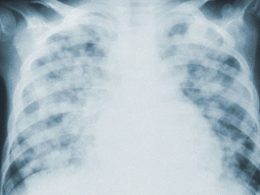 Researchers Find Extensive Lung Damage in COVID-19 Corpses