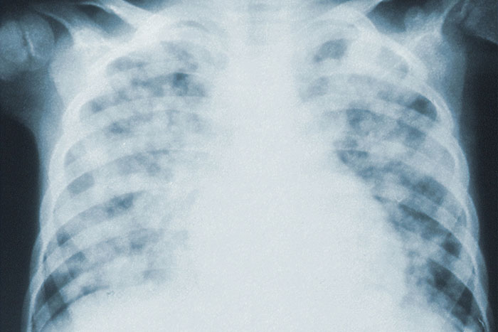 Researchers Find Extensive Lung Damage in COVID-19 Corpses